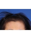 Before Hair Transplant &nbsp;Hair Thinning